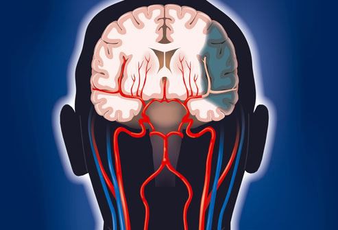 phototake_rm_photo_of_brain_damage_from_stroke phototake_rm_photo_of_brain_damage_from_stroke